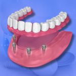 Cost of Dental Implant Mumbai