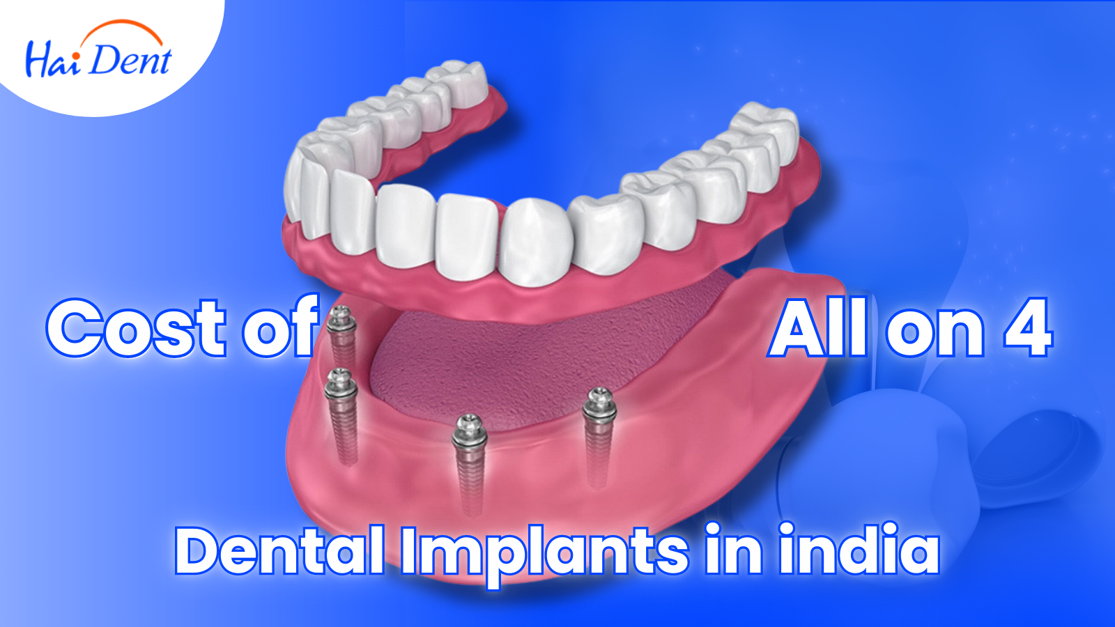 All-on-4 Dental Implants In India