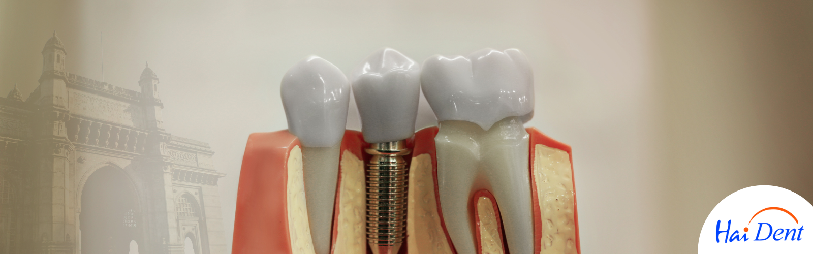 COST OF DENTAL IMPLANTS IN MUMBAI