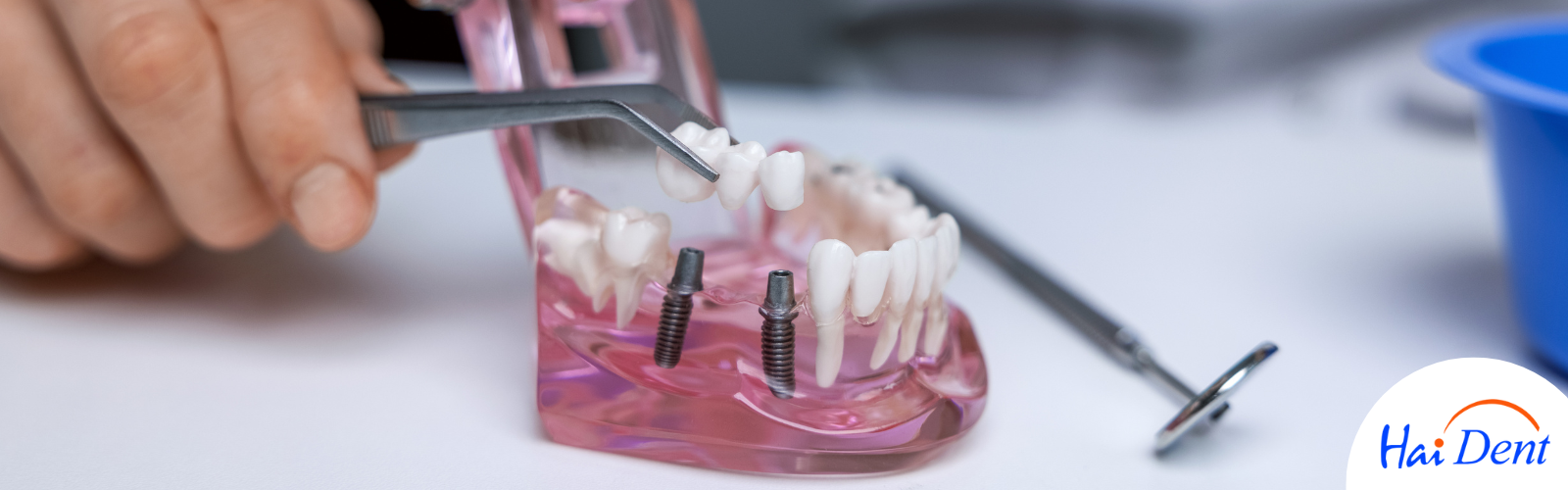 FULL MOUTH DENTAL IMPLANTS COST IN MUMBAI