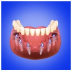 all-on-6-dental-implants-cost-in-india