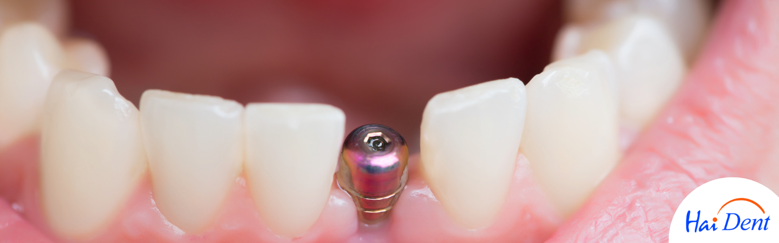 SINGLE TOOTH IMPLANT COST IN MUMBAI