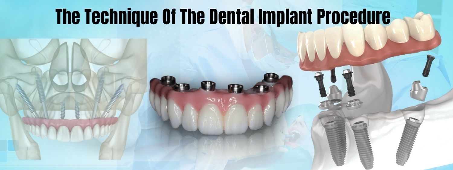 type of dental implant in delh