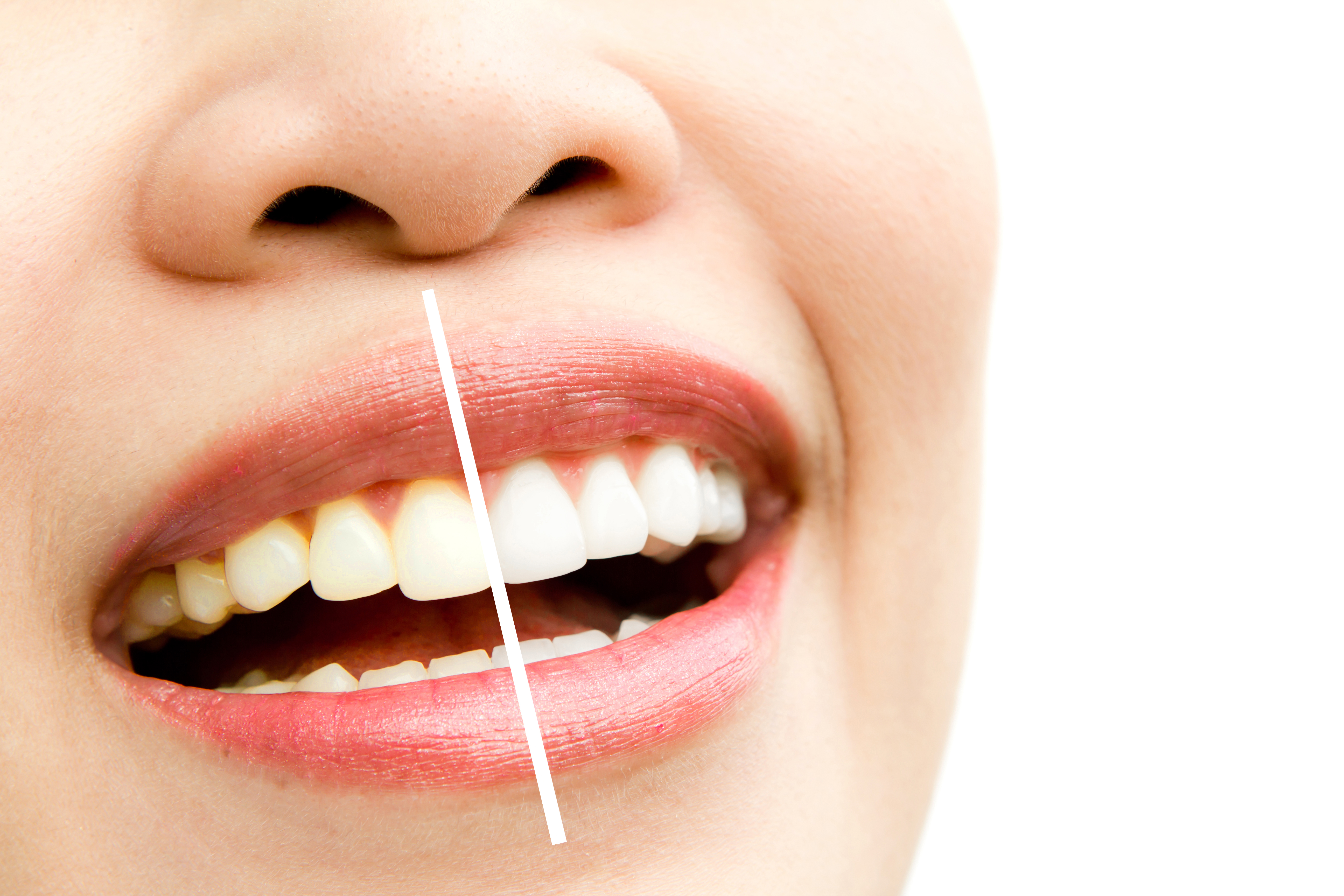 TEETH WHITENING BY BEST DENTIST IN MUMBAI