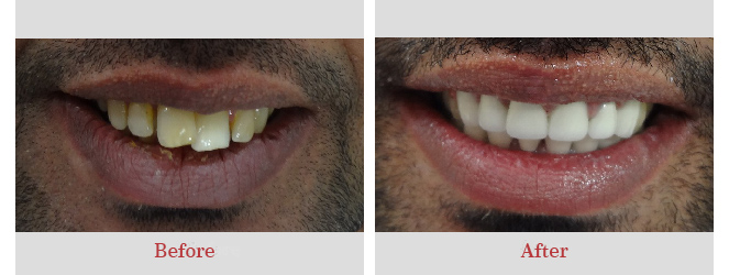 طرقة علاج الاسنان