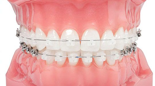 orthodontist in gurgaon