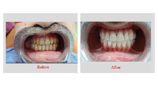 best dental implant clinic in gurgaon