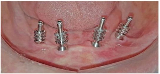 Best Dental Implant Clinic in Mumbai