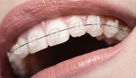 cost of braces in gurgaon