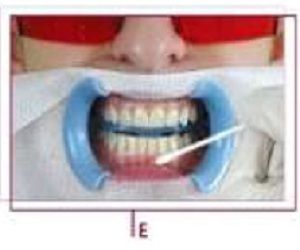 teeth whitening cost