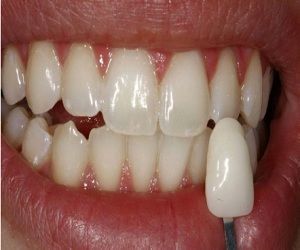 teeth whitening cost