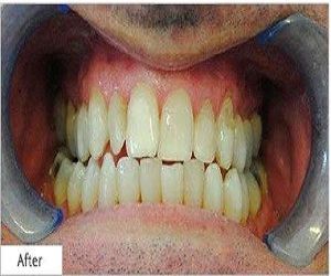 teeth whitening cost