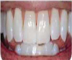 best teeth whitening