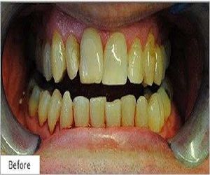 teeth whitening cost