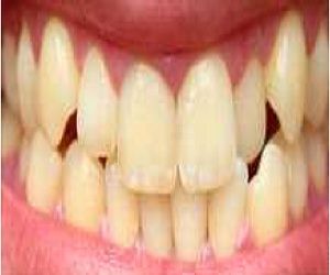 teeth whitening cost