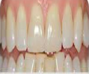 teeth whitening cost