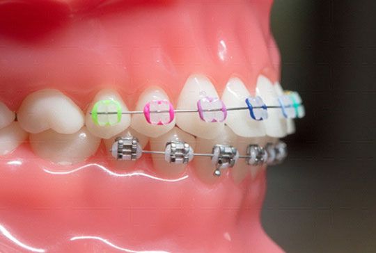 cost of braces in gurgaon