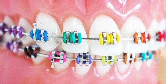 cost of braces in gurgaon