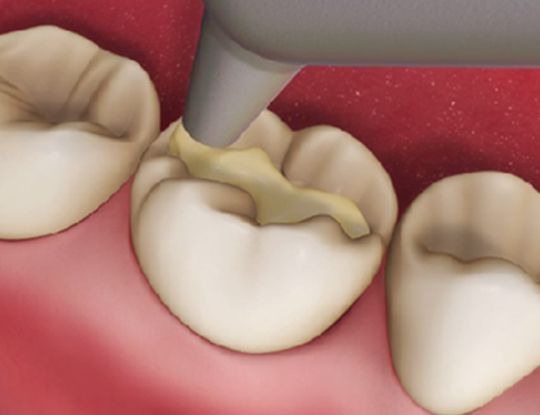 composite tooth filling cost