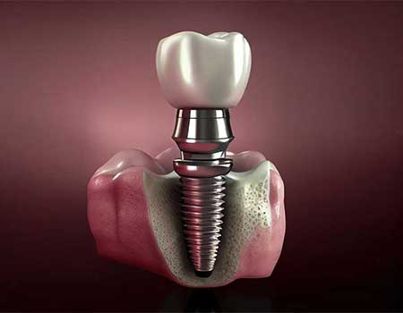 Best Dental Implants Clinic in Mumbai