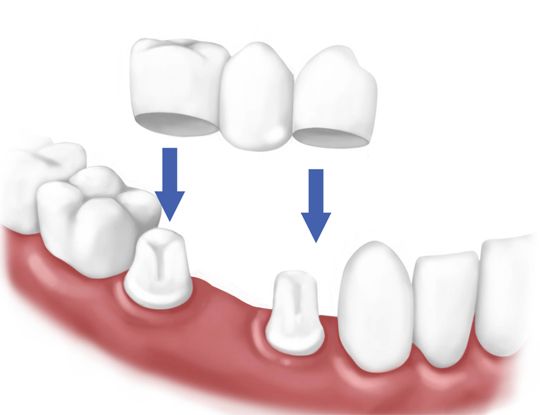 Tooth Crown