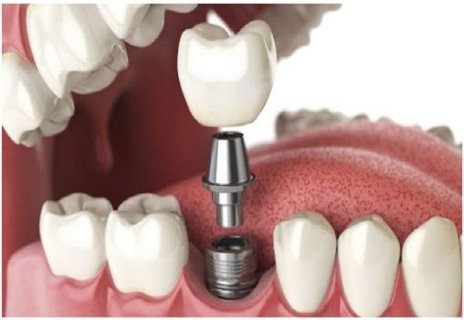 Best Dental Implant Clinic in Mumbai