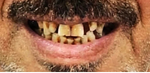 Patient teeth before full mouth dental implant treatment at HaiDent Mumbai — missing teeth case