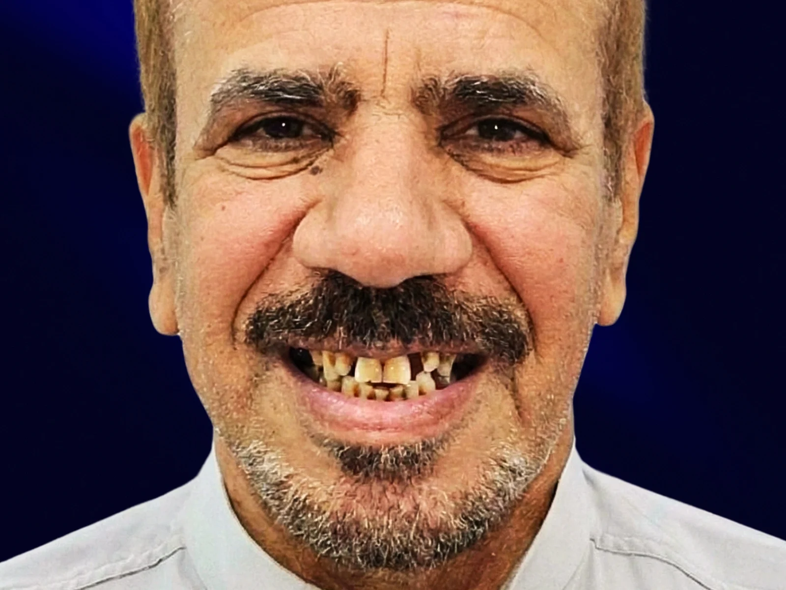 Cosmetic dentistry — beautiful smile after treatment at HaiDent before