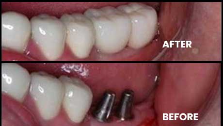 Best Dental Implants Clinic in Mumbai