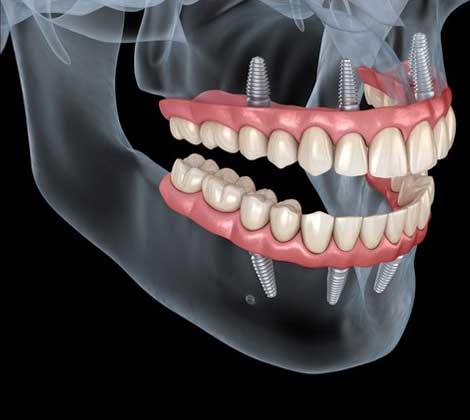 Best Dental Implant Clinic in Mumbai