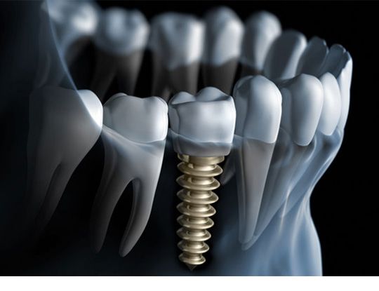 Best dental implant hospitals in India