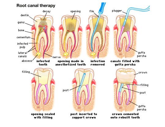 root canal treatment in india