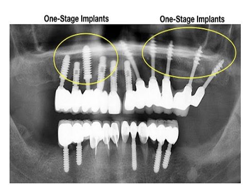 Best Dental Implant Clinic in Mumbai