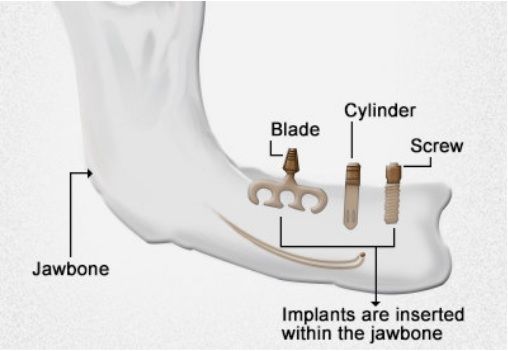 Best Dental Implant Clinic in Mumbai